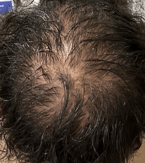 Before Image: Patient # 4612 - front