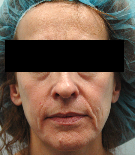 Before Image: Patient # 41753 - 
