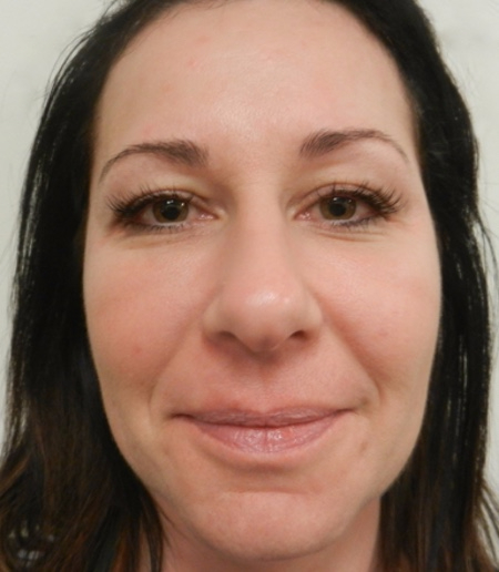 After Image: Patient # 66548 - 