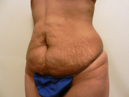 Before Image: Patient # 84605 - 