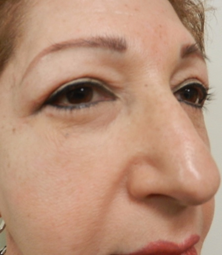 After Image: Patient # 67366 - 