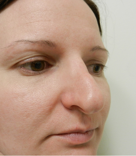 Before Image: Patient # 36416 - 