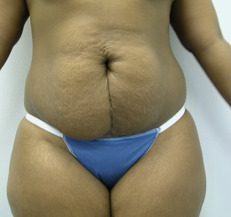 Before Image: Patient # 39176 - 