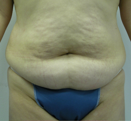 Before Image: Patient # 14787