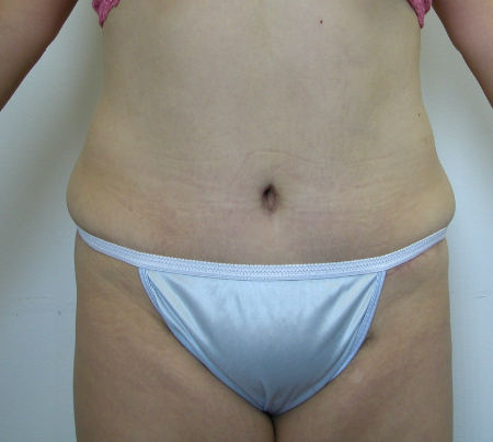 After Image: Patient # 14787