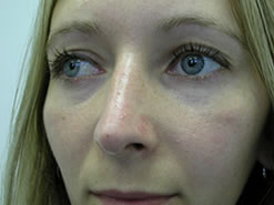 After Image: Patient # 23611 - 