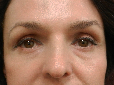 After Image: Patient # 35271 - 