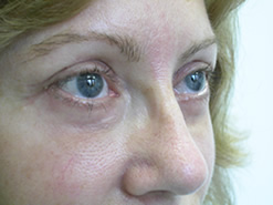 After Image: Patient # 39324 - 