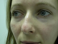 Before Image: Patient # 23611 - 