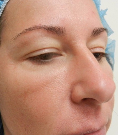 Before Image: Patient # 66548 - 