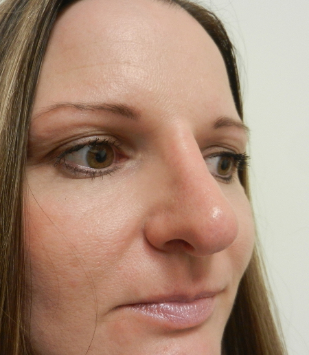 After Image: Patient # 36416 - 