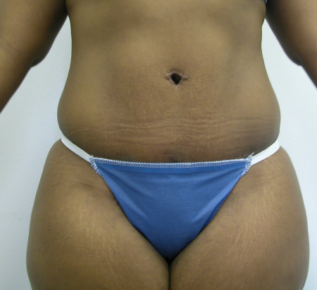 After Image: Patient # 39176 - 