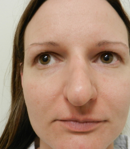 Before Image: Patient # 36416 - 