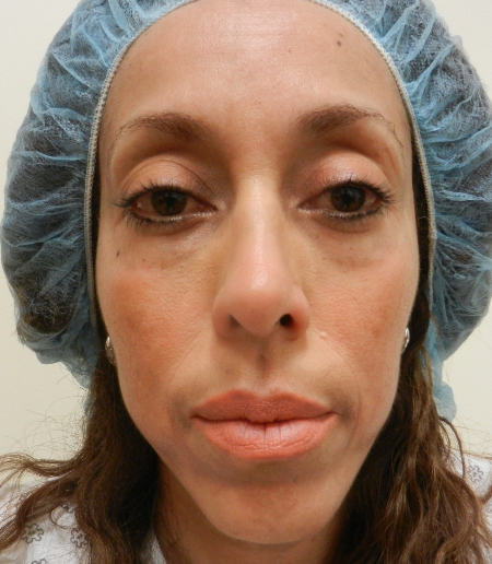 Before Image: Patient # 92852 - 