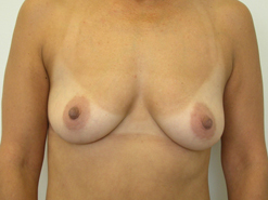 Before Image: Patient # 29671 - 