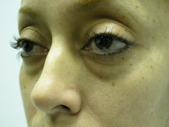 Before Image: Patient # 72282 - 