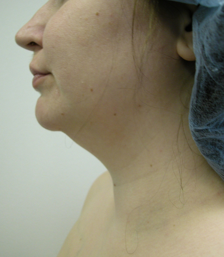 Before Image: Patient # 32789 - 