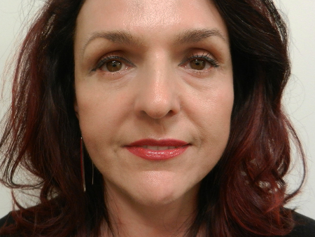 After Image: Patient # 95309 - 