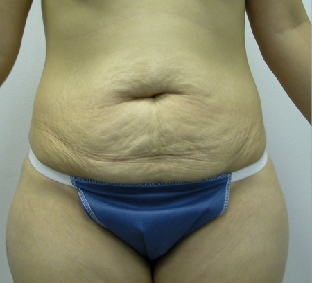 Before Image: Patient # 29744 - 