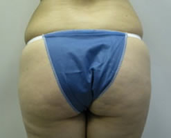 Before Image: Patient # 49714 - 