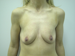 Before Image: Patient # 30782 - 