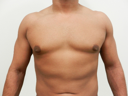 After Image: Patient # 85461 - 