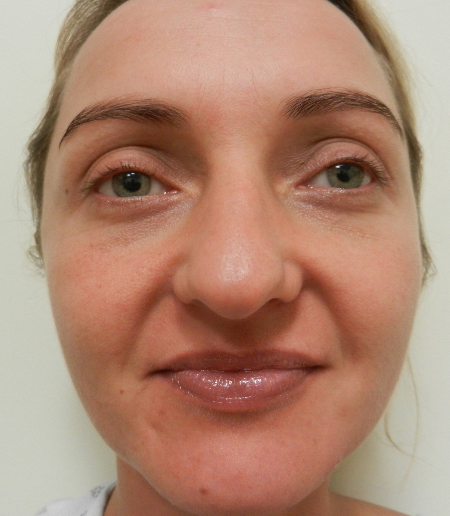 Before Image: Patient # 32662 - 