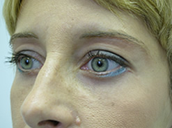 After Image: Patient # 57571 - 