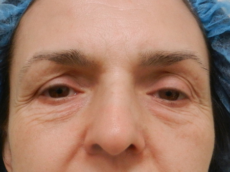 Before Image: Patient # 35271 - 