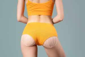 Slim female body with surgical lines on buttocks, illustrating Brazilian butt lift, liposuction, and fat transfer concepts