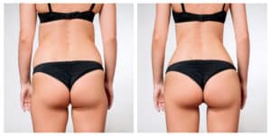 Female,Body,Before,And,After,Liposuction.,Plastic,Surgery,Concept. A woman's rounded, shapely butt after a butt lift
