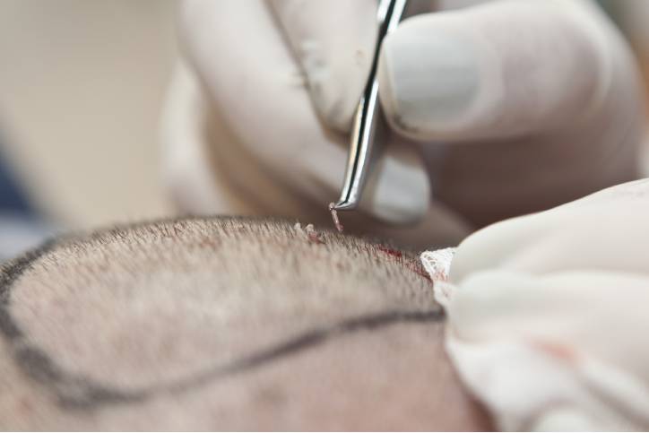 The Evolution and Popularity of Hair Transplants