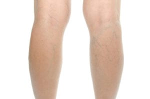 varicose-veins