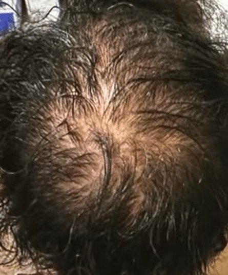 before Hair Loss Treatment Chicago IL