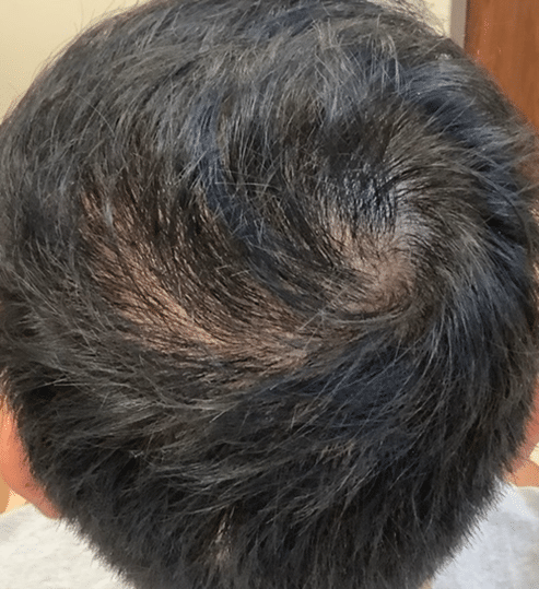 After Hair Restoration Treatment Chicago IL